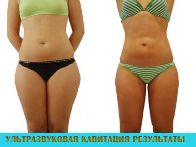 ультразвуковая кавитация безоперационная липосакция ультразвуковая кавитация безоперационная липосакция